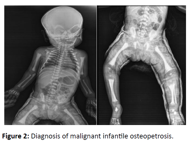 preventive-medicine-infantile-osteopetrosis